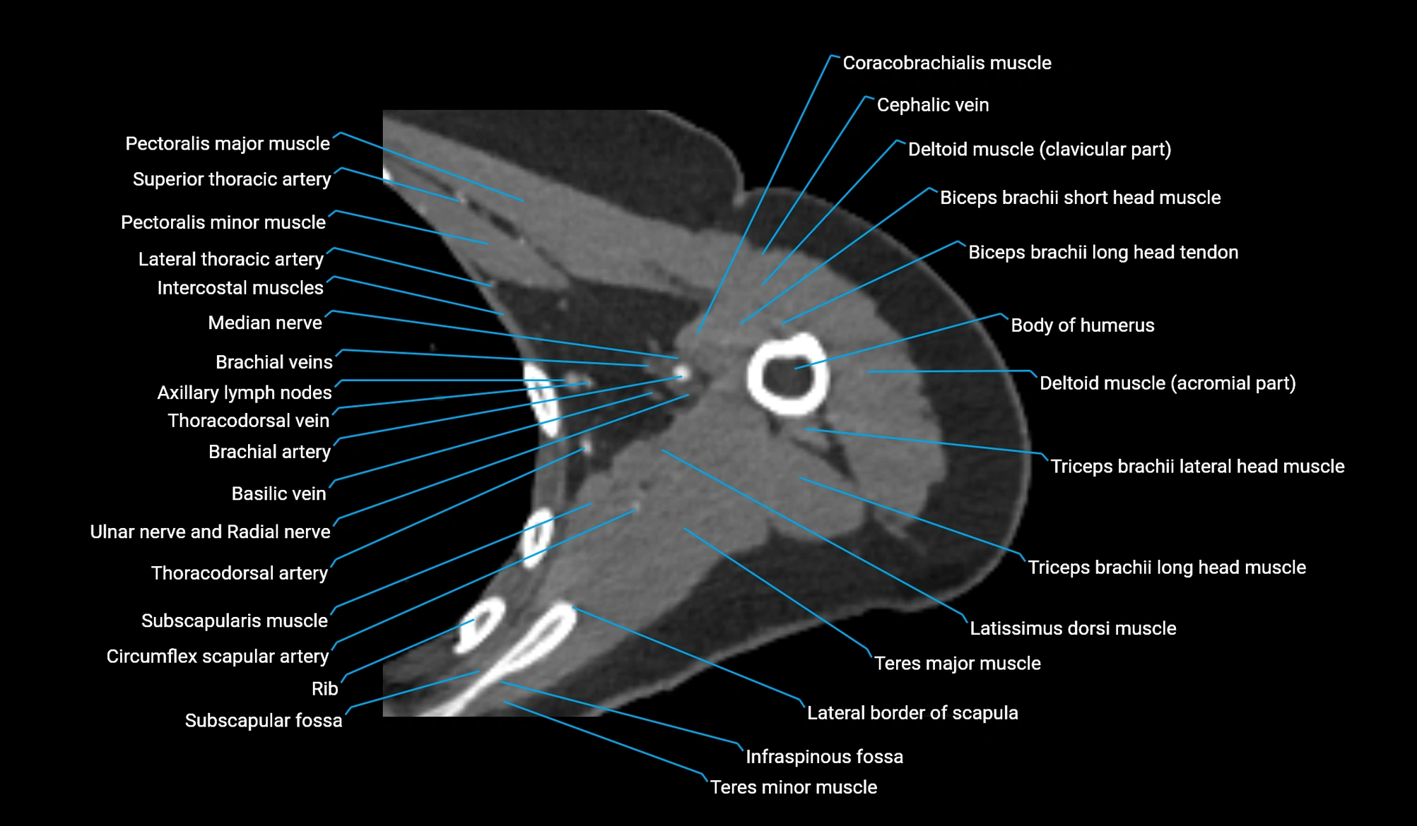 CT upper arm axial  cross sectional anatomy labelled radiology image -00148.webp